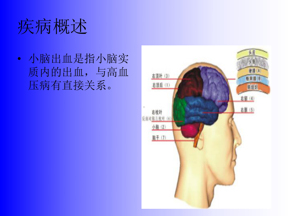 小脑出血-PPT课件.ppt_第2页