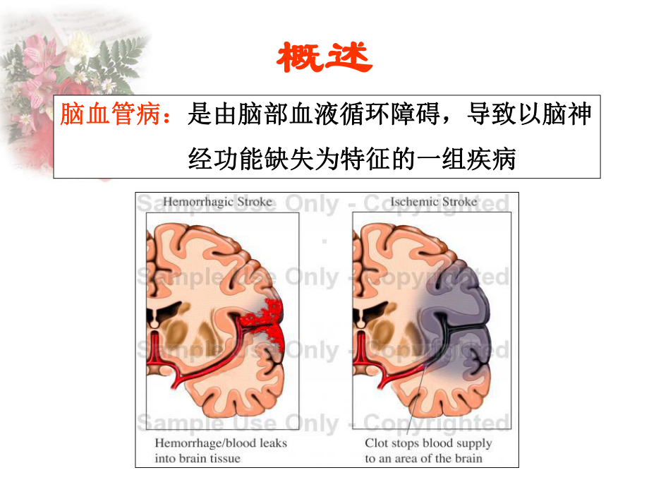 缺血性脑血管病-脑梗塞课件.ppt_第2页