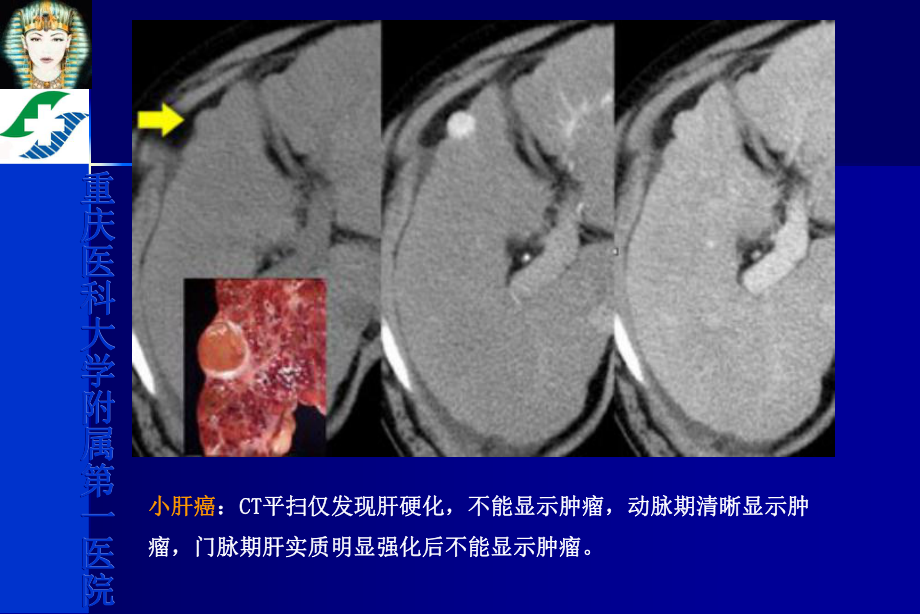 肝脏肿块影像诊断与鉴别诊断课件.ppt_第3页