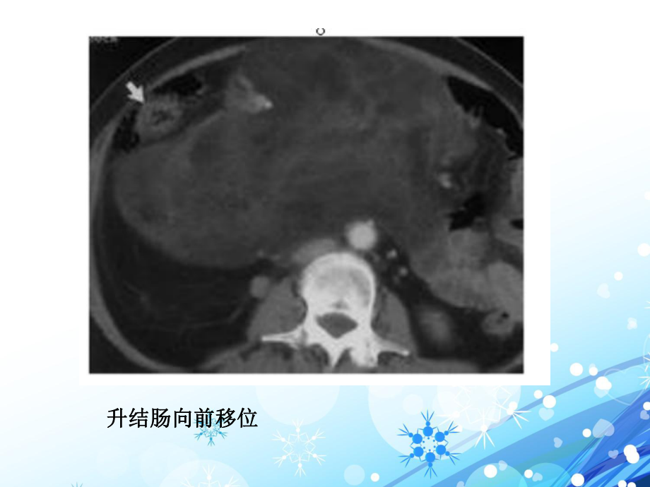 腹膜后神经源性肿瘤-ppt课件1.ppt_第3页