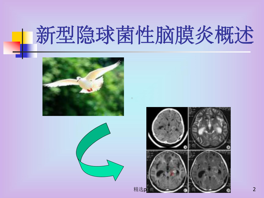 《隐脑的护理》PPT课件.ppt_第2页