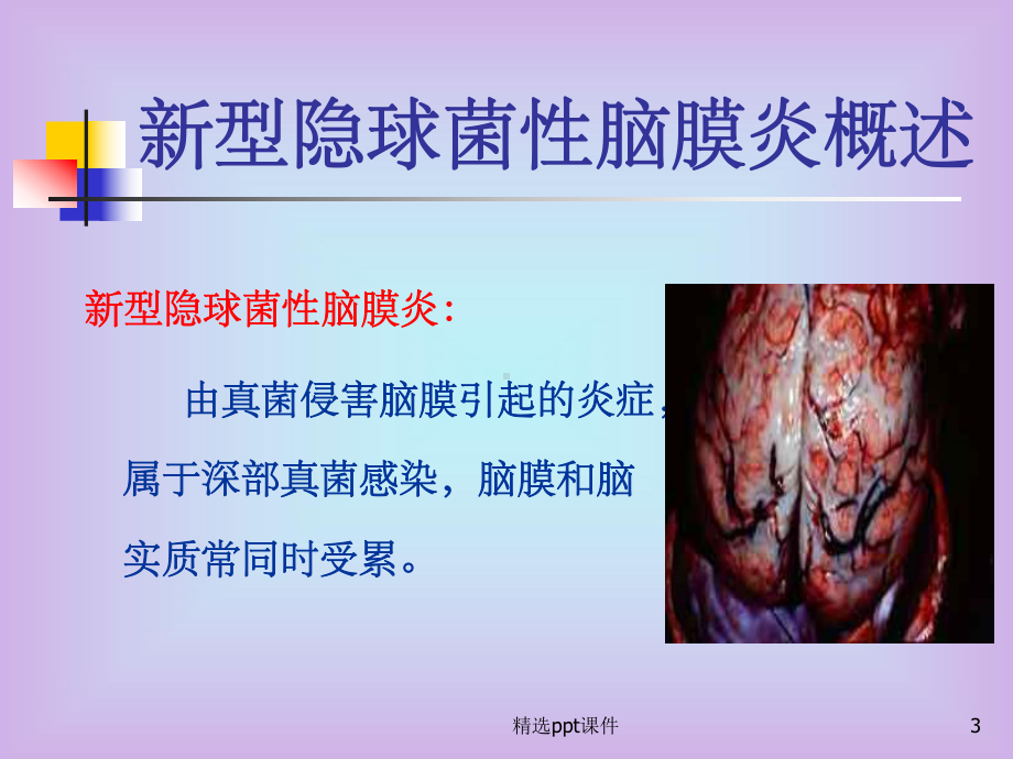 《隐脑的护理》PPT课件.ppt_第3页