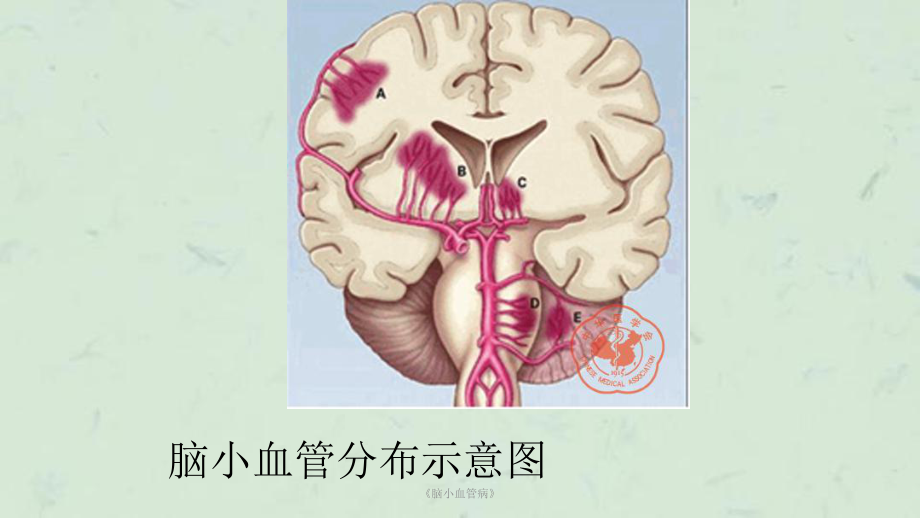 《脑小血管病》课件.ppt_第3页