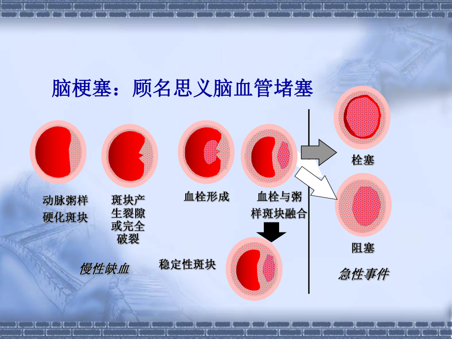 急性脑梗死静脉溶栓的护理课件.ppt_第3页