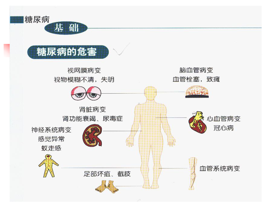 糖尿病与脑梗塞PPT课件.ppt_第2页