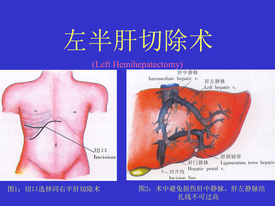 左半肝切除术-PPT课件.ppt_第1页