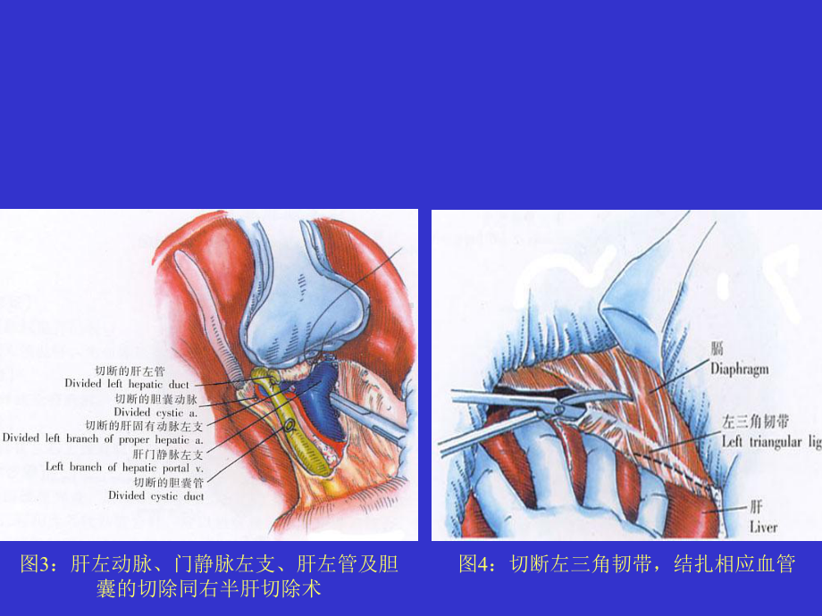 左半肝切除术-PPT课件.ppt_第2页