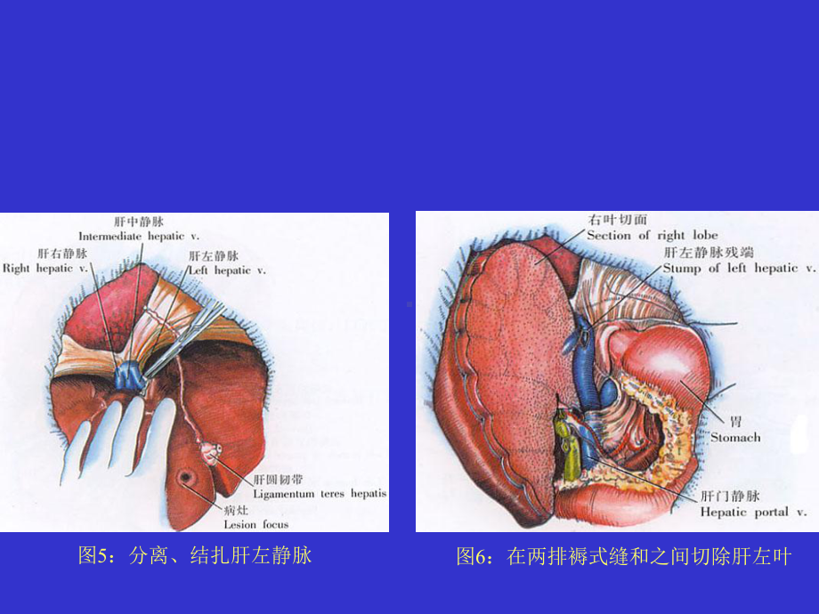 左半肝切除术-PPT课件.ppt_第3页