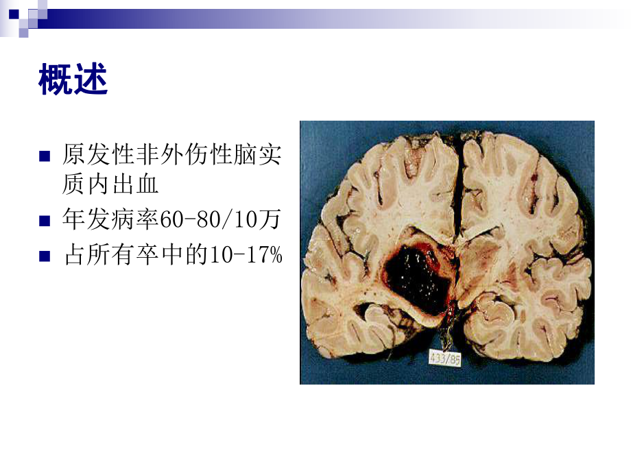 脑出血-课件.ppt_第2页