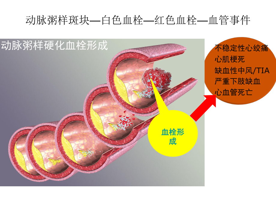 最新急性脑梗死rtPA溶栓治疗主题讲座课件.ppt_第2页