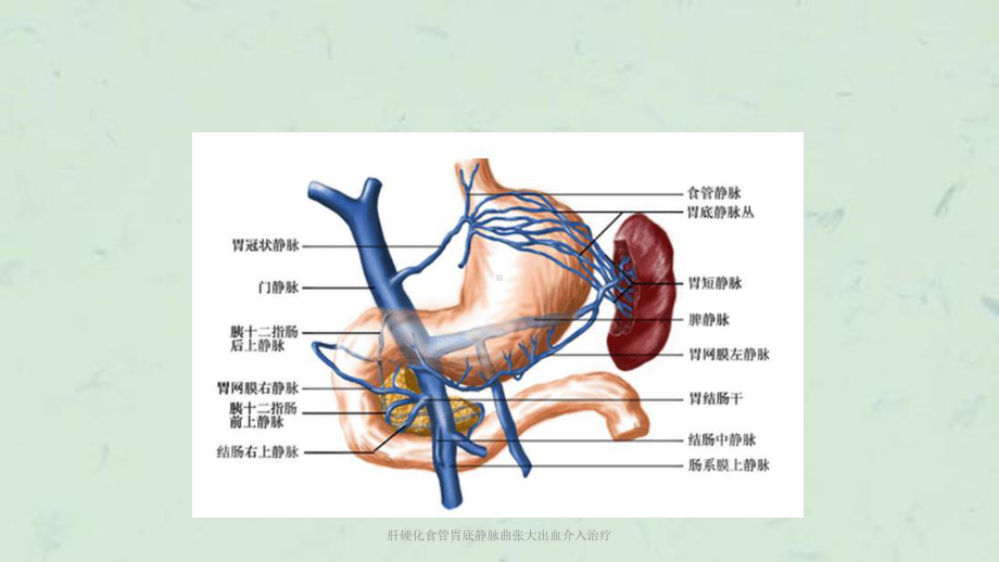 肝硬化食管胃底静脉曲张大出血介入治疗课件.ppt_第3页
