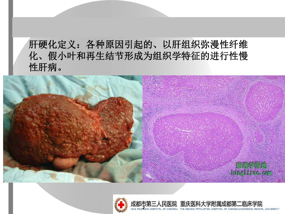 内科学肝硬化ppt课件.ppt_第2页