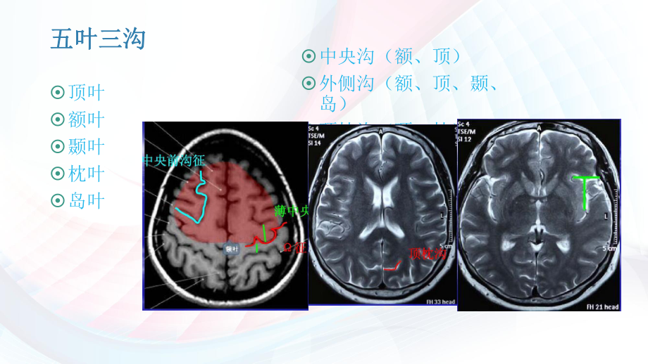 神经系统颅脑CT影像断层解剖及正常CT表现课件.ppt_第3页