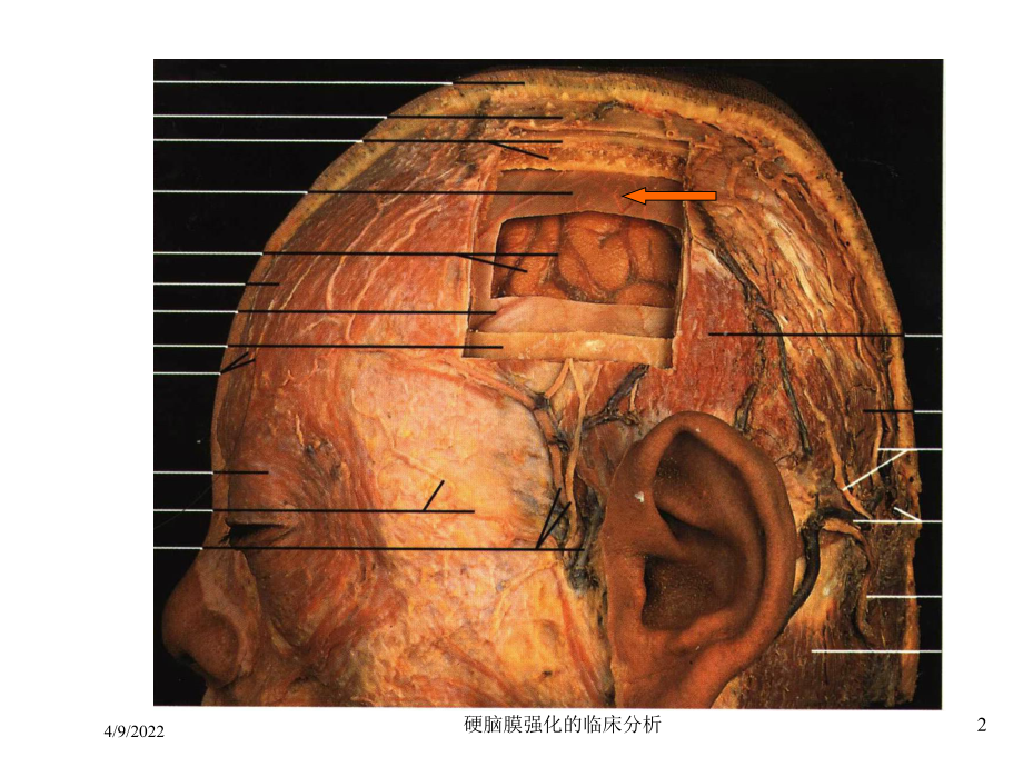 硬脑膜强化的临床分析培训课件.ppt_第2页