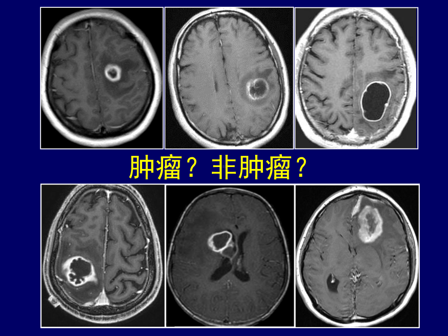 脑内常见环形强化病变影像诊断与鉴别诊断课件.ppt_第2页