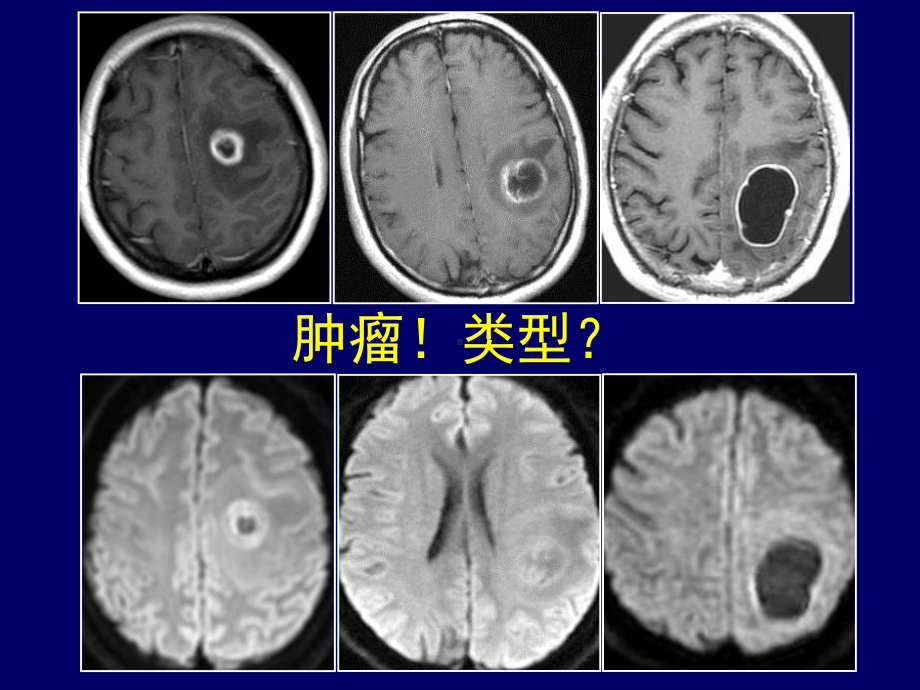 脑内常见环形强化病变影像诊断与鉴别诊断课件.ppt_第3页