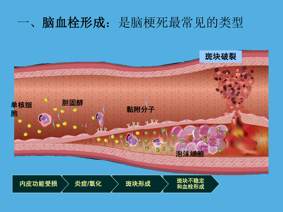 脑梗死ppt课件.ppt_第2页