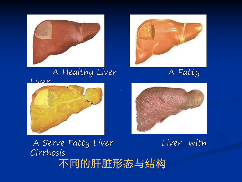 重症肝炎感染的特征与抗微生物治疗策略课件.ppt_第3页