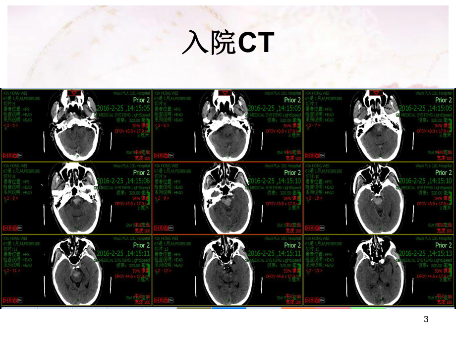 脑干出血治疗体会PPT课件.ppt_第3页