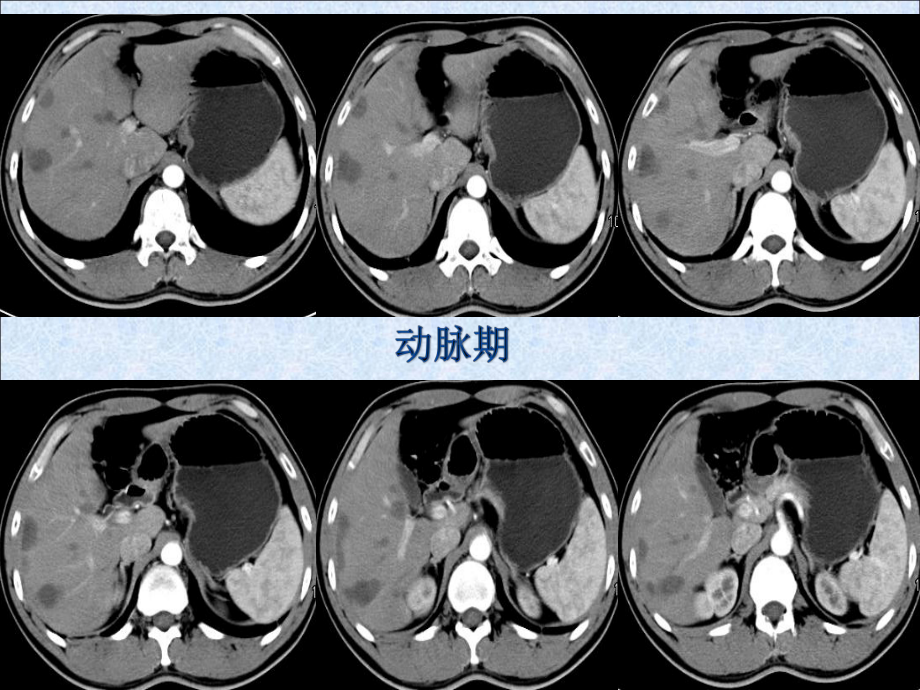 肝脏血管外皮瘤的影像表现ppt课件.pptx_第2页