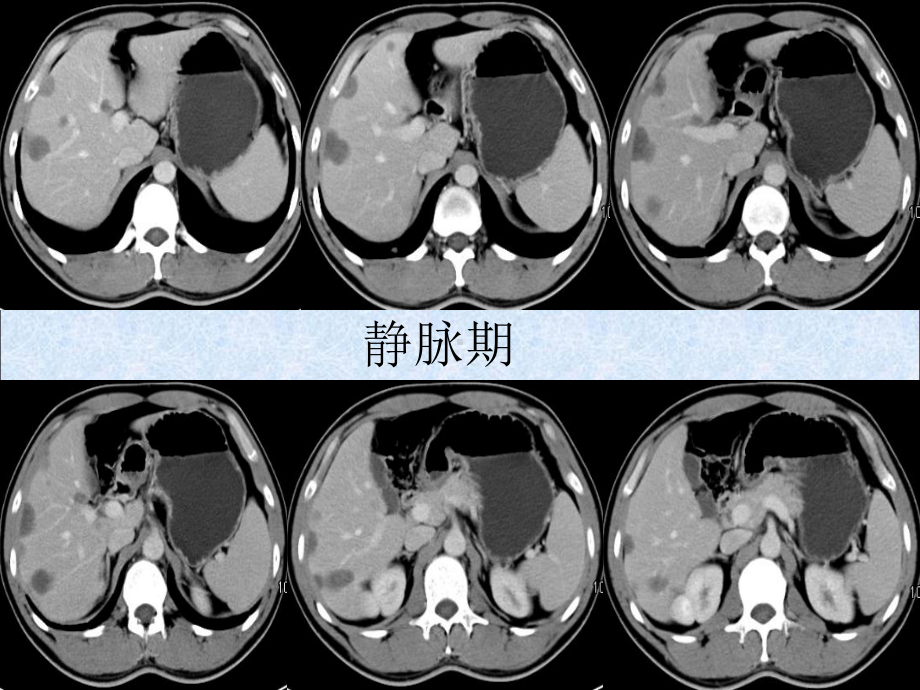 肝脏血管外皮瘤的影像表现ppt课件.pptx_第3页