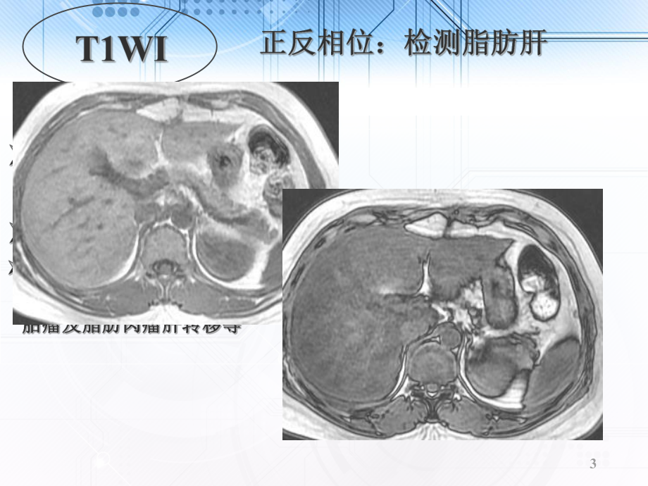 肝脏病变的MRI诊断-ppt课件.ppt_第3页