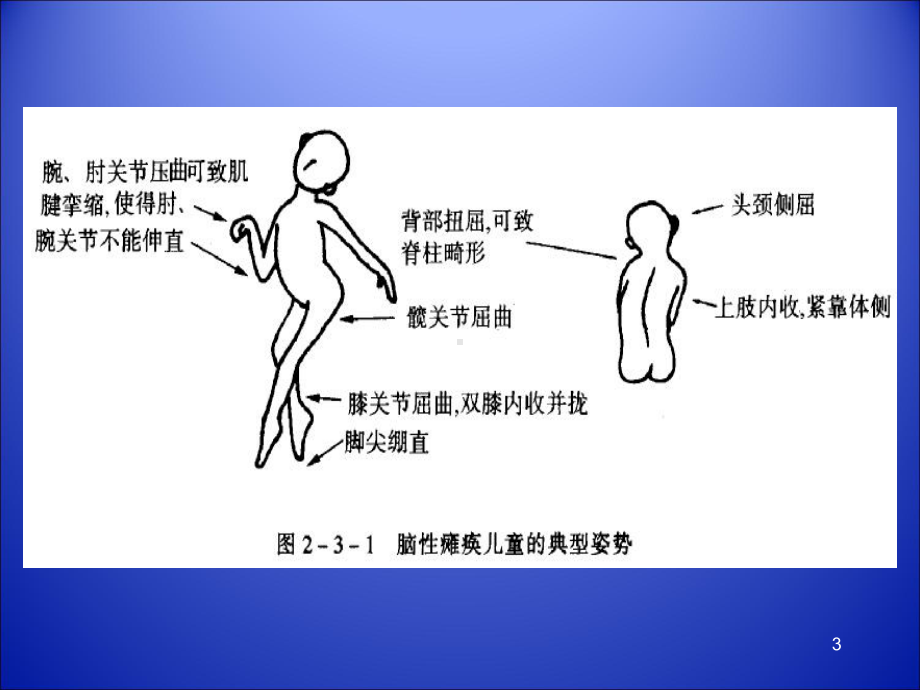 小儿脑瘫康复PPT课件.ppt_第3页