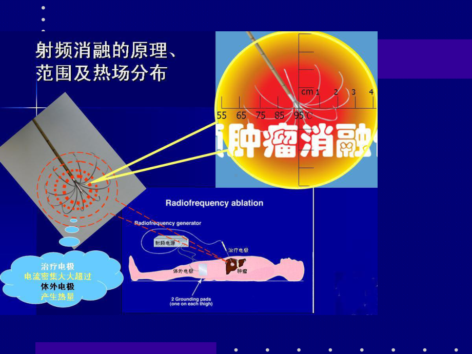 关于肝癌射频消融手术课件.ppt_第3页