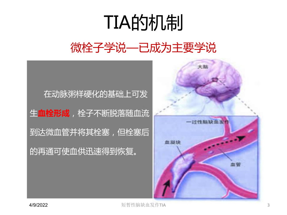 短暂性脑缺血发作TIA培训课件.ppt_第3页