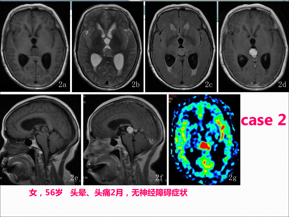 中枢神经细胞瘤影像表现课件.ppt_第3页