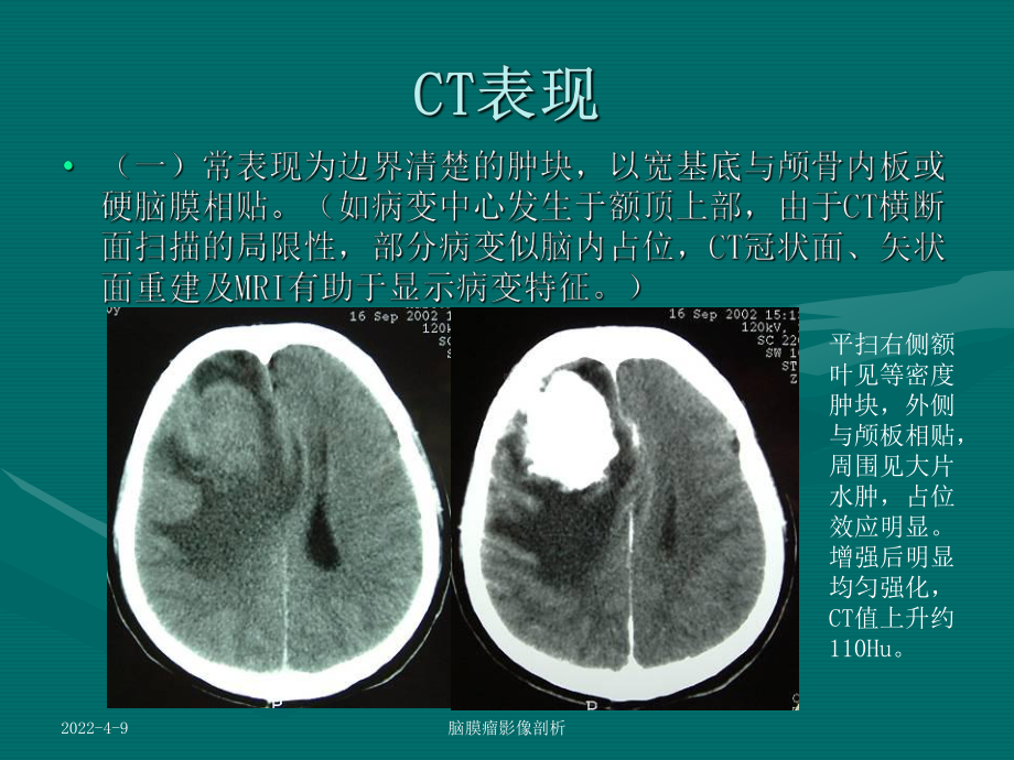 脑膜瘤影像学诊断课件.ppt_第3页