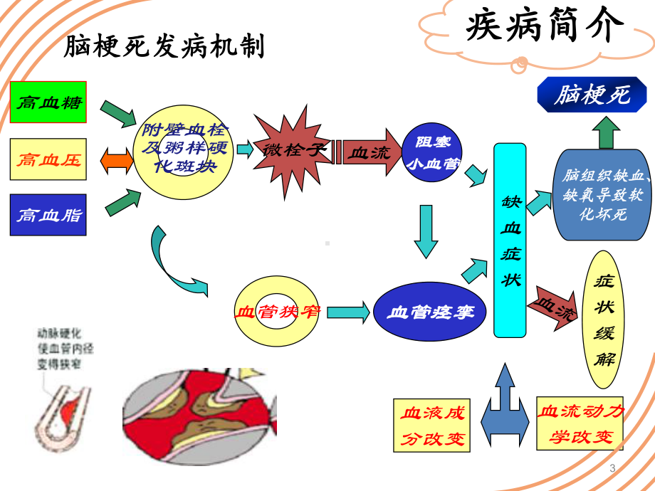 一例急性心梗合并脑梗患者的病例分析课件.ppt_第3页