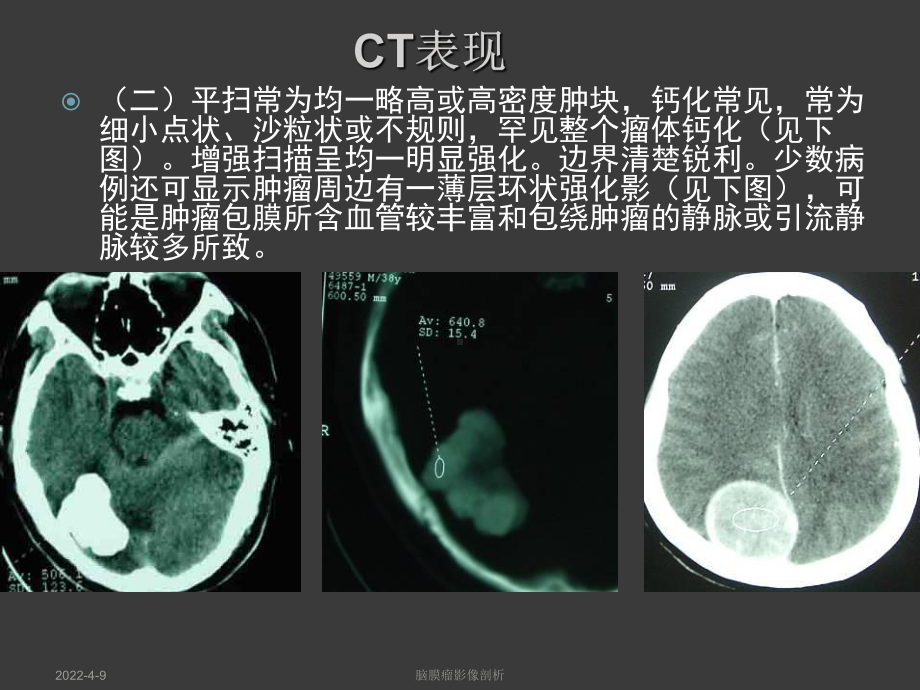 医学课件脑膜瘤影像学表现.ppt_第3页