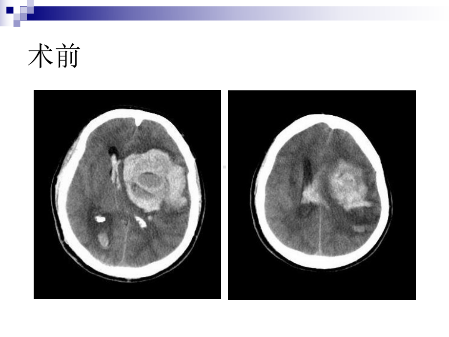 脑外科教学查房课件.ppt_第2页