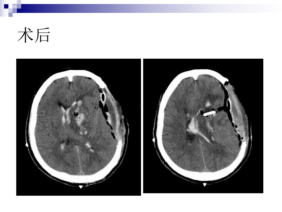 脑外科教学查房课件.ppt_第3页