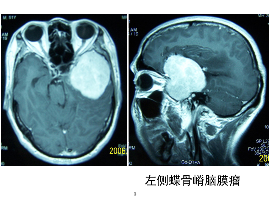 神经外科切口设计（最终版）PPT课件.ppt_第3页