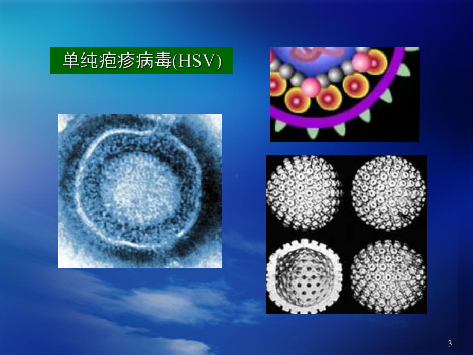 单纯疱疹病毒性脑炎PPT幻灯片课件.ppt_第3页