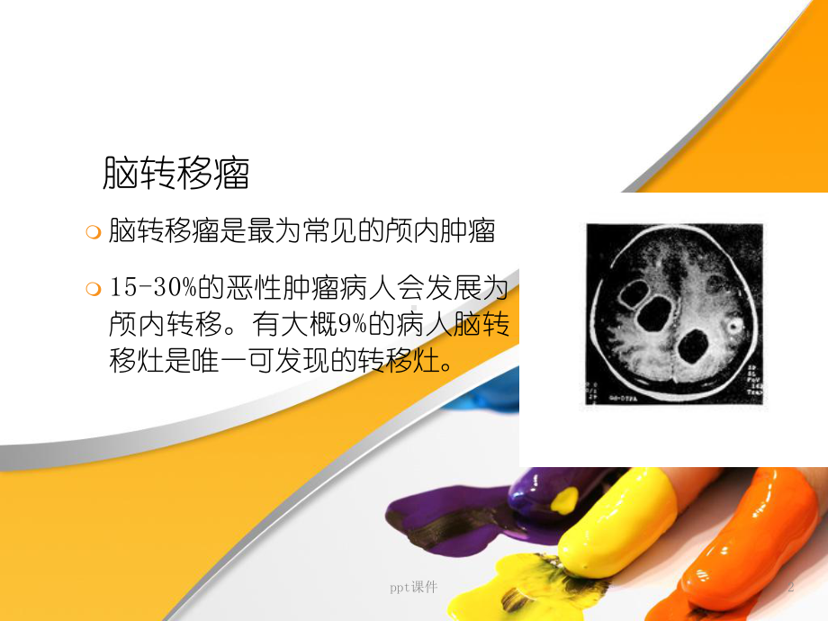 脑转移瘤-ppt课件.ppt_第2页