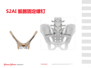 S2AI螺钉植入技巧PPT课件.ppt