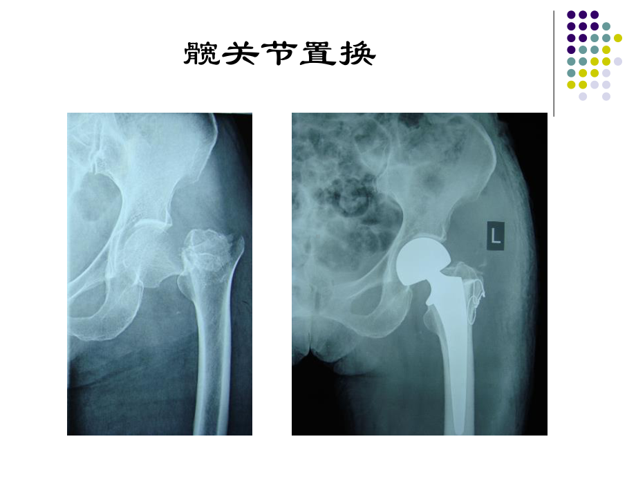 1髋膝关节置换术后功能锻炼指导精品PPT课件.pptx_第3页