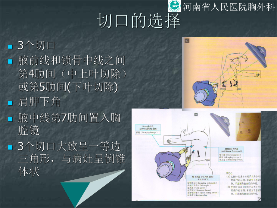 VATS下肺叶切除图解PPT课件.ppt_第2页