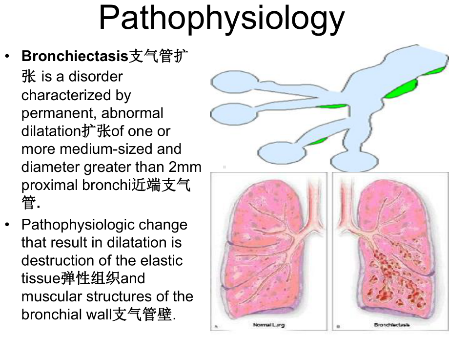 内科护理学课件-英语-考试Bronchiectasis.ppt_第2页