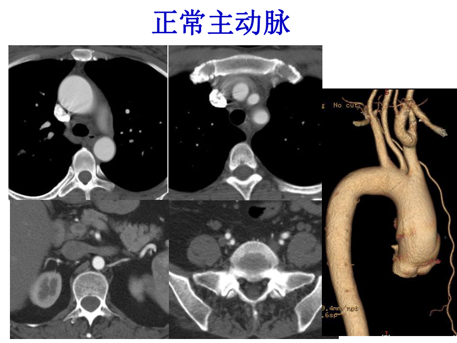 主动脉瘤MDCT诊断与临床课件.ppt_第3页