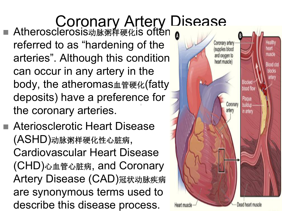 内科护理学课件-英语-考试Coronary-Artery-Disease.ppt_第2页