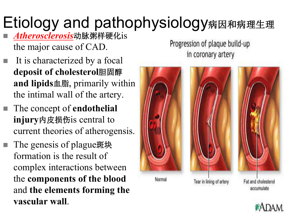 内科护理学课件-英语-考试Coronary-Artery-Disease.ppt_第3页