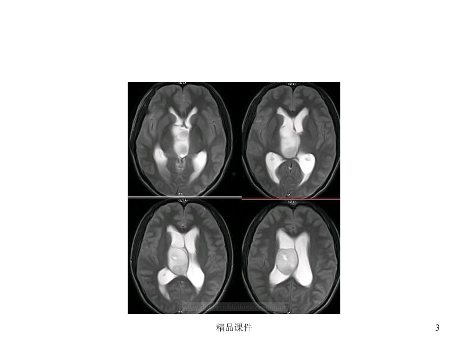 侧脑室内的常见肿瘤课件.ppt_第3页