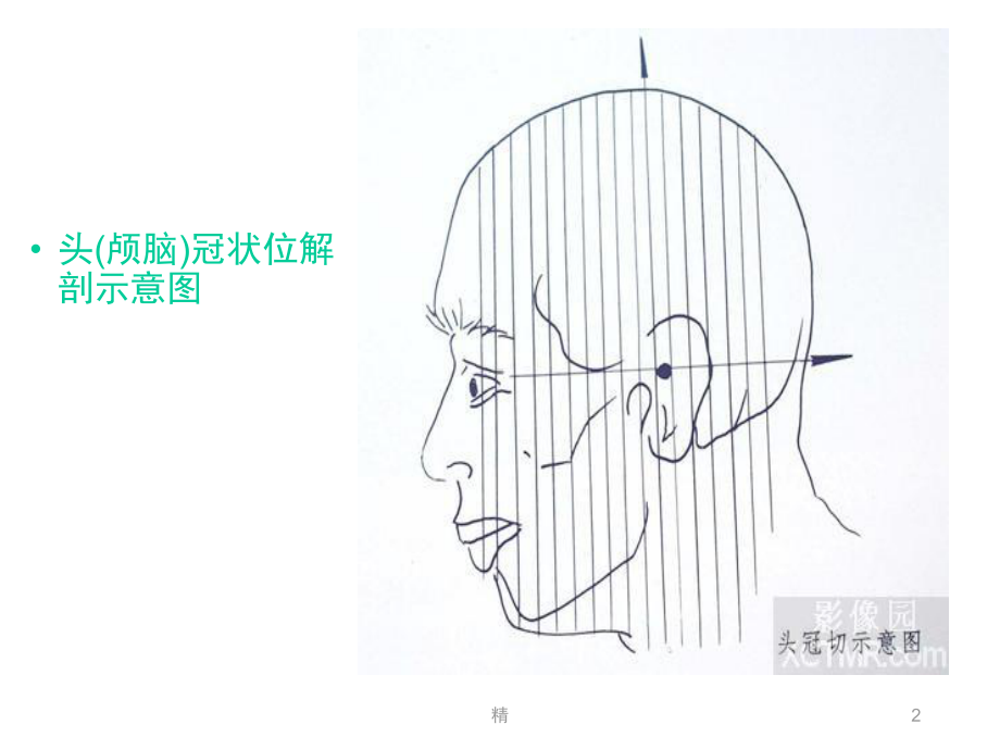 人体断层解剖图谱大脑-头(颅脑)冠状位解剖示意图-精选课件.ppt_第2页