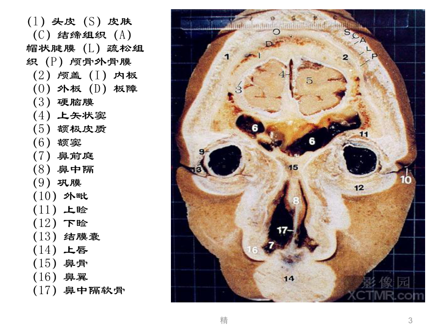 人体断层解剖图谱大脑-头(颅脑)冠状位解剖示意图-精选课件.ppt_第3页