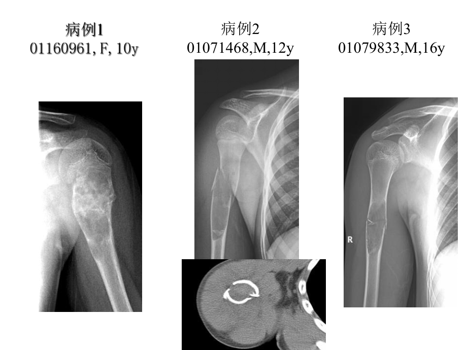 动脉瘤样骨囊肿的X线CT鉴别课件.ppt_第3页