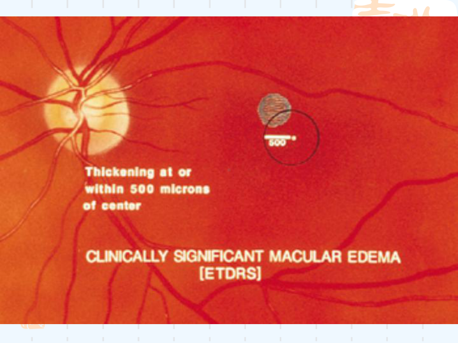 糖尿病性黄斑水肿课件.ppt_第3页